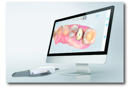 3D Intraoral Scanner